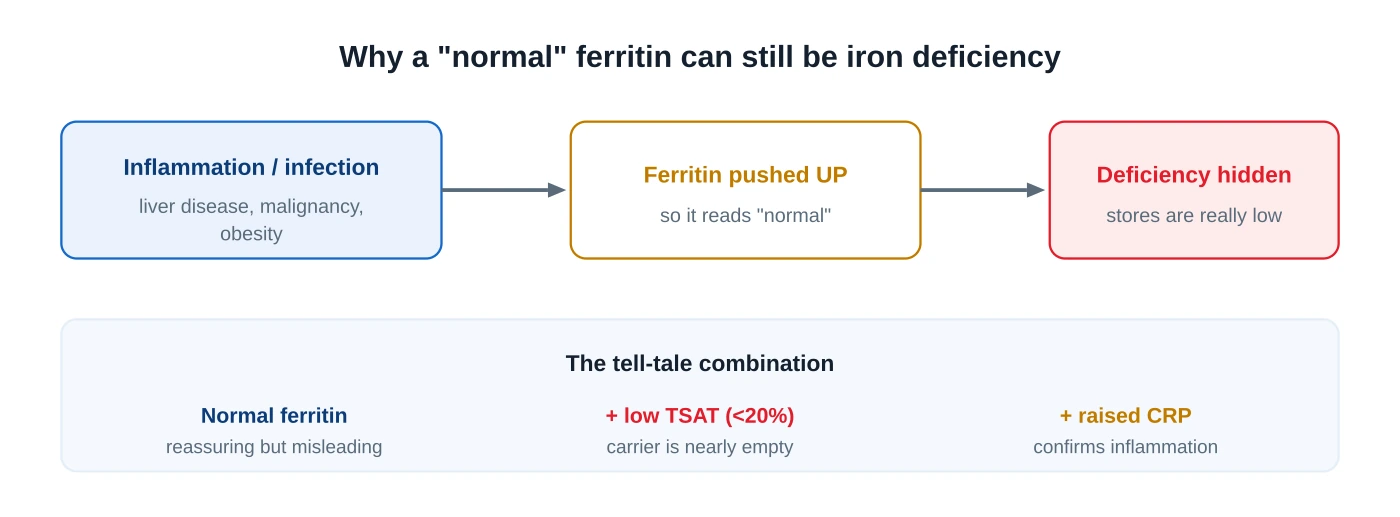 Diagram showing that inflammation raises ferritin so a normal ferritin plus a low transferrin saturation plus a raised CRP can still mean iron deficiency